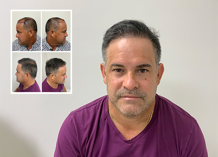 La Transformación de Humberto Quílez con Care4Hair