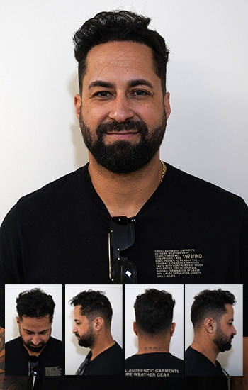 rivaldo rodriguez hair transplant final results photo