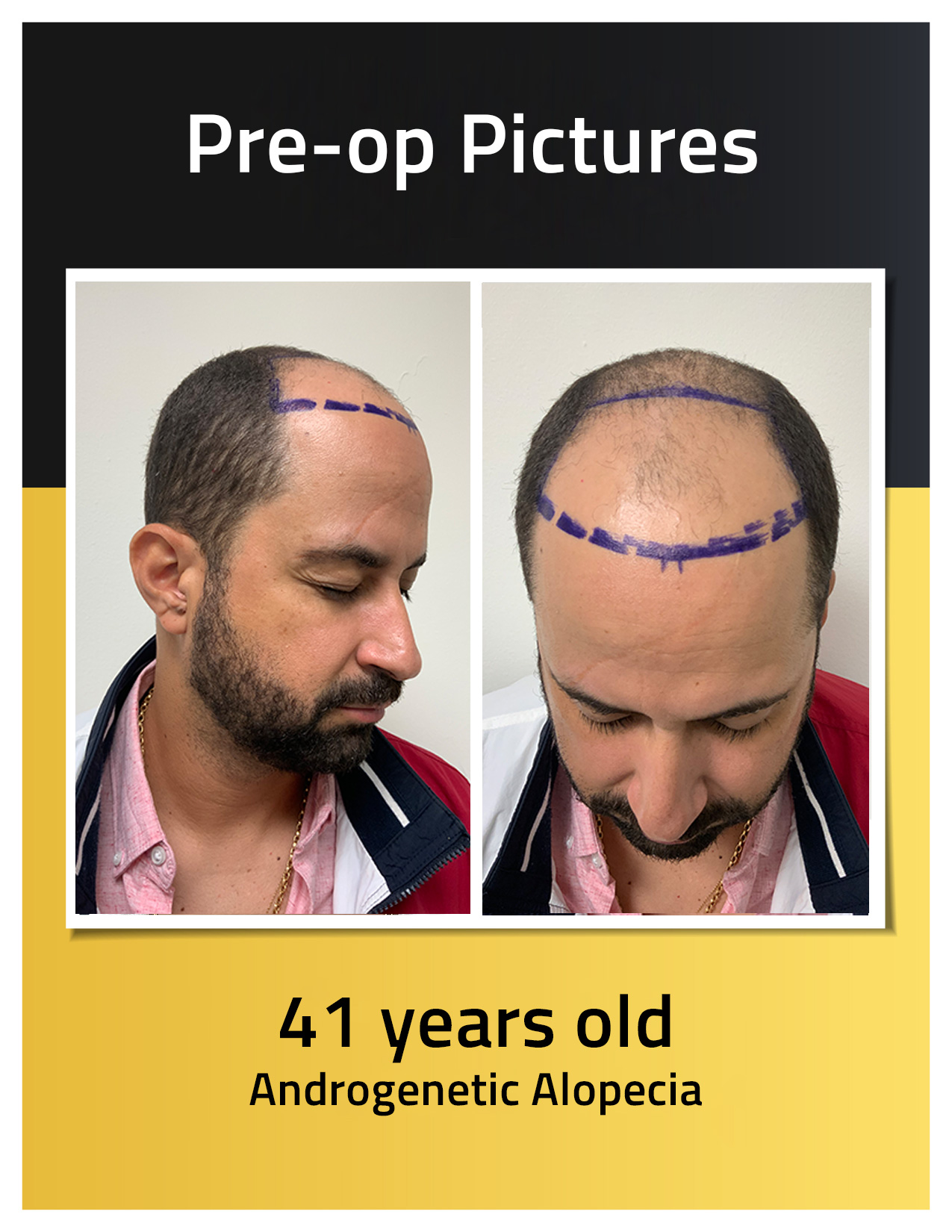 rivaldo rodriguez hair transplant pre op photos