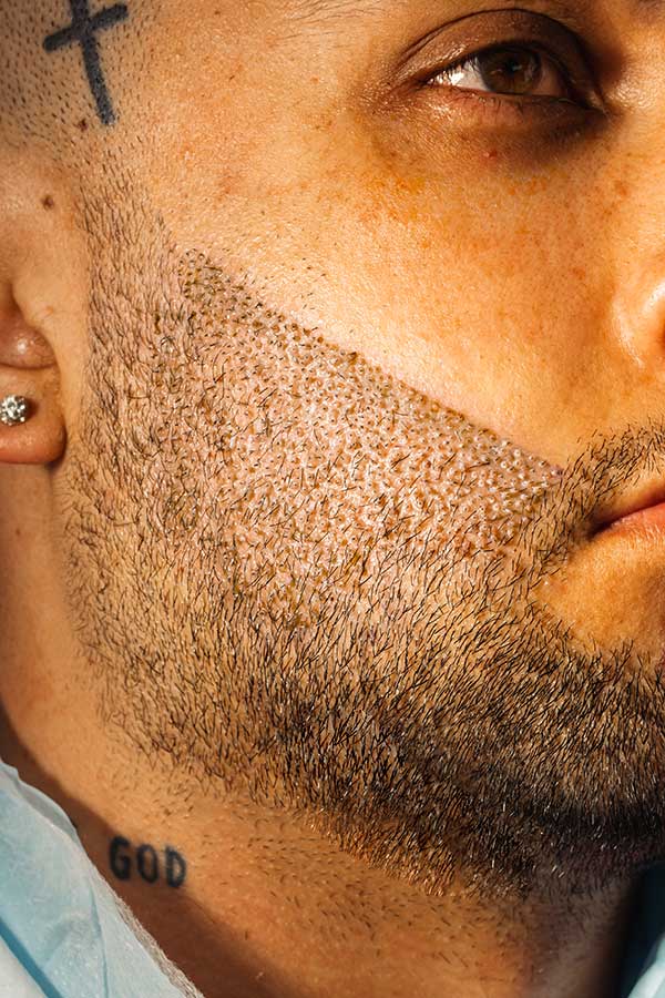 beard hair transplant 1500 grafts