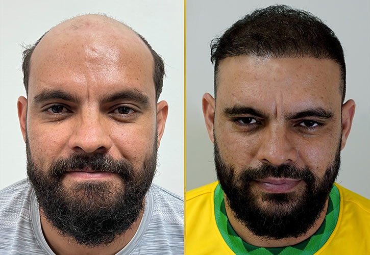 Is this normal hair shedding after a hair transplant? (photos)