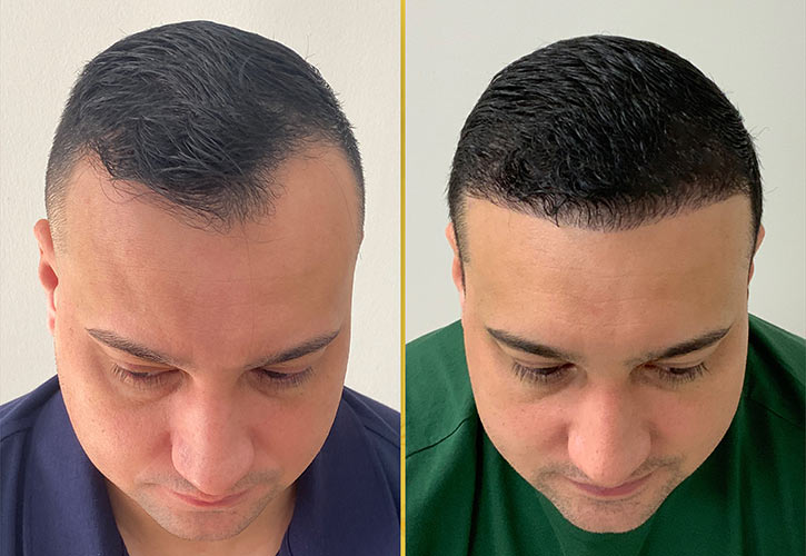 When is a hair transplant the right option?
