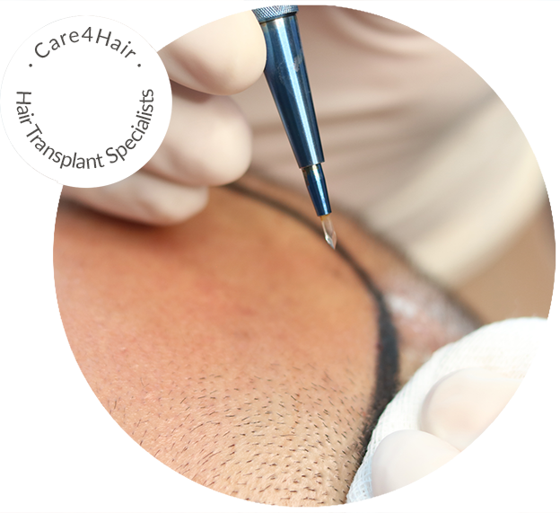 Sapphire FUE technique