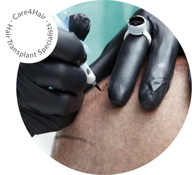 scalp micropigmentation in Miami