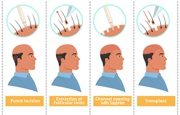Sapphire FUE hair transplant Steps