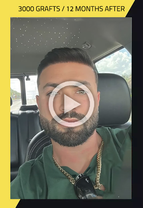 Male FUE hair transplant before and after video, case 16