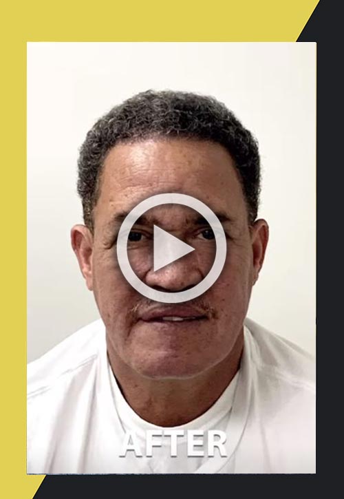 Caso 17 de restauración de cabello étnico