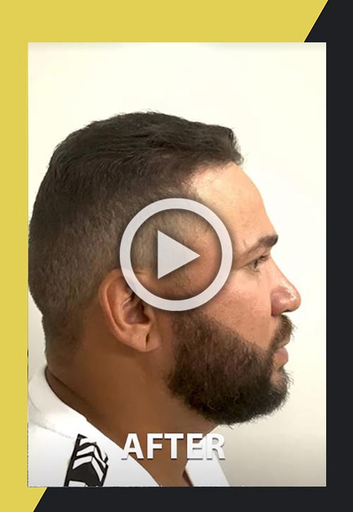 Trasplante de Pelo Facial de la Barba - Vídeo de caso 18