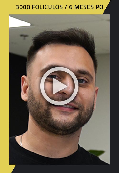 Paciente de trasplante de cabello con 3000 injertos, 6 meses después