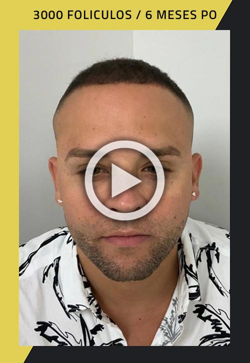 Vídeo de un paciente con trasplante de cabello FUE de 3000 folículos, 6 meses después