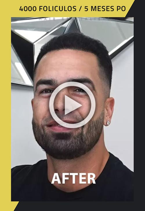 Video de paciente de restauración capilar con 4000 foliculos cinco meses después