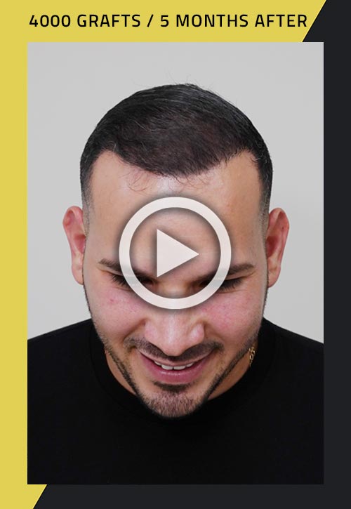 4000-grafts hairline restoration surgery video 5 months after