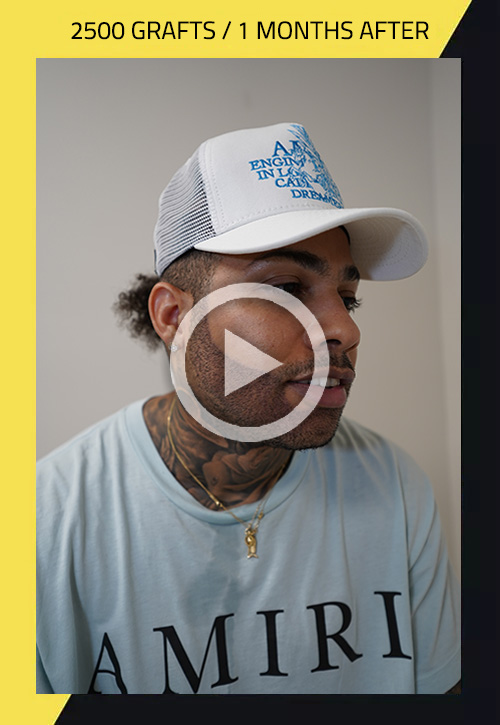 African-american patient beard transplant - case 23 video