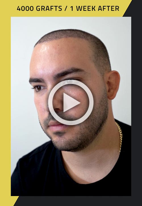 4000-grafts hair restoration surgery video 1 week after