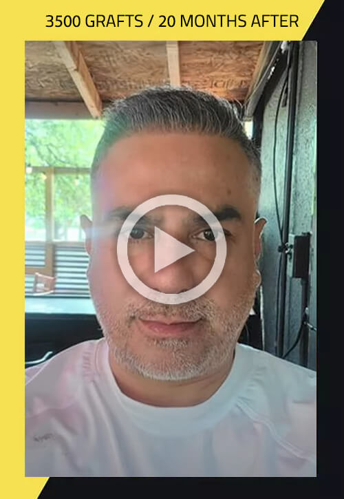 Hair Restoration Surgery video - Patient case #25