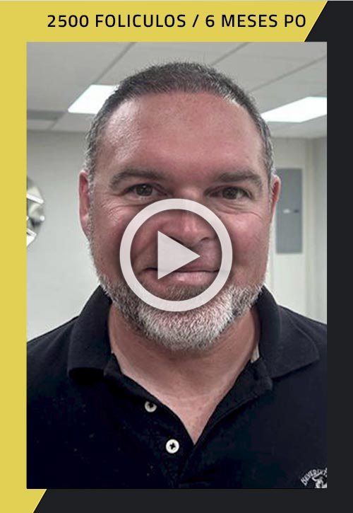 Video de Paciente de trasplante de cabello de 2500 injertos, 6 meses después