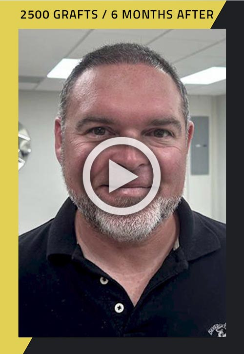 2500-graft hair transplant patient 6 months after video