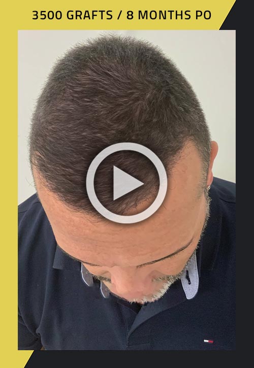 3500-grafts hair transplant 8 months after surgery video