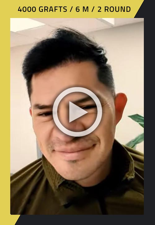 4000-grafts second-round hair transplant 6 months after surgery video