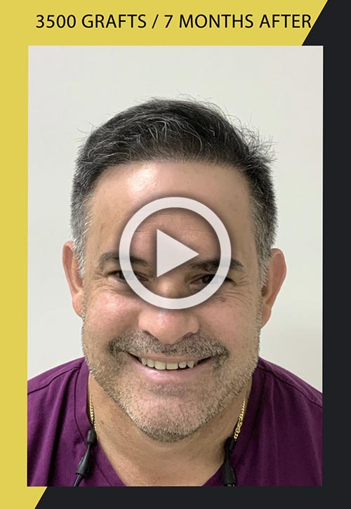 Vídeo de trasplante de cabello de 3500 folículos siete meses después