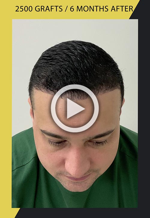 2500-grafts hair transplant 6 months after video