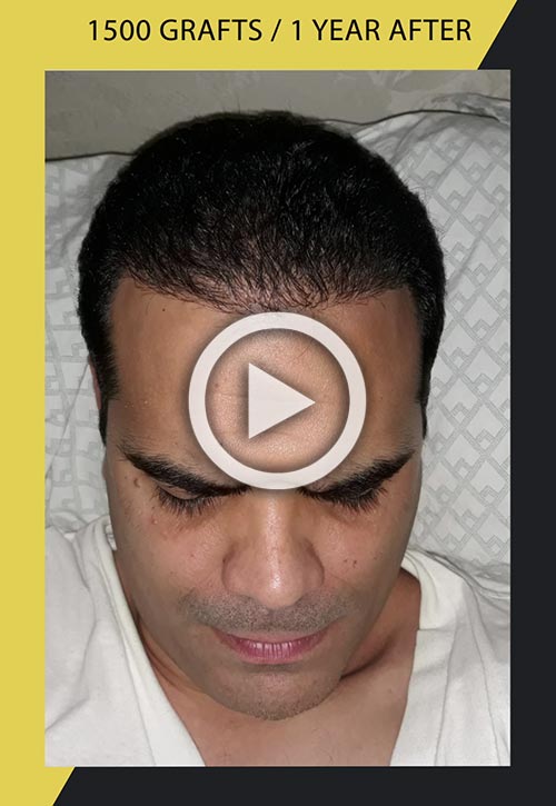 Hair Transplant Videos Gallery Care4hair