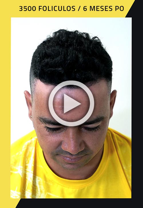 Vídeo de trasplante de cabello de 3500 injertos 6 meses después