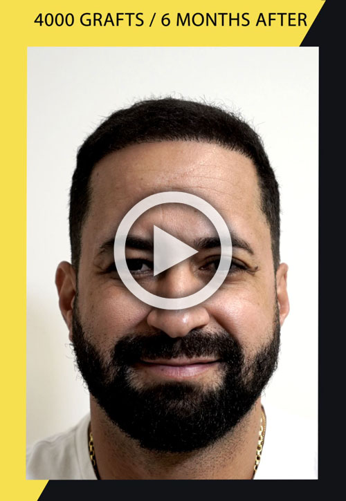 4000 grafts hair transplant 6 months after video