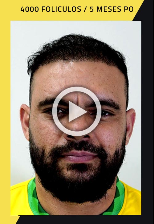 Vídeo de trasplante de cabello de 4000 injertos 5 meses después