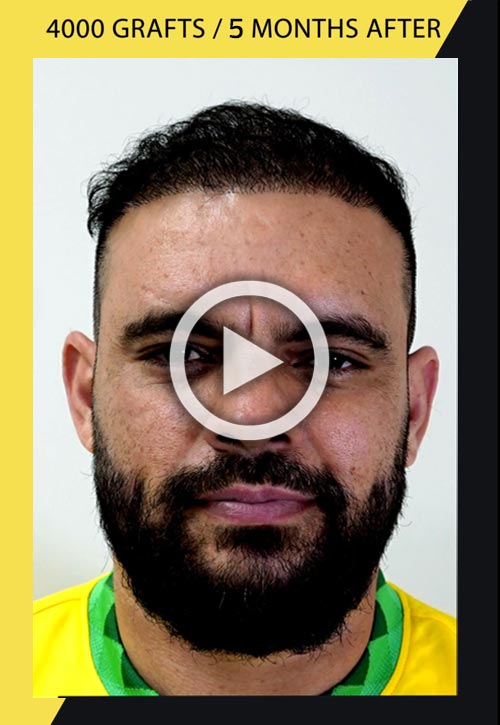 4000 grafts hair transplant 5 months after video