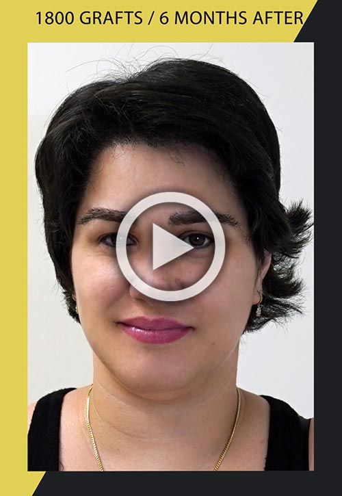 1800 grafts female hairline restoration 6 months after video