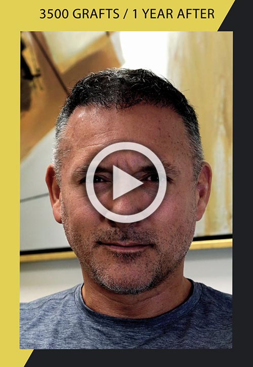 3500-follicles hair transplant video one year after surgery