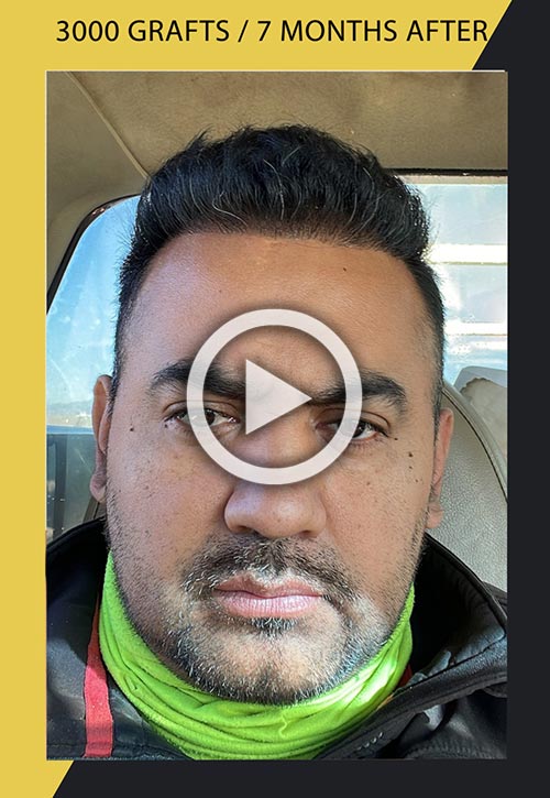 3000 grafts hair transplant 7 months after video
