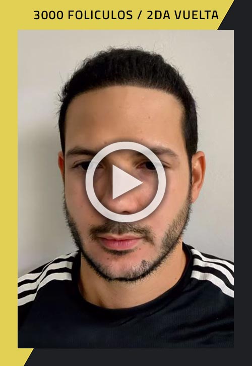 Vídeo: Segunda ronda de cirugía de trasplante de cabello con 3000 foliculos