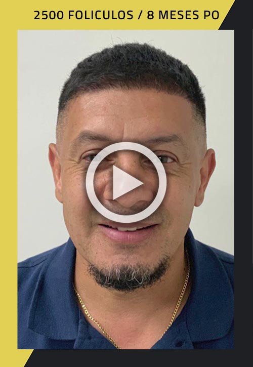 Vídeo de trasplante de cabello de 2500 injertos 8 meses posteriores a la cirugía