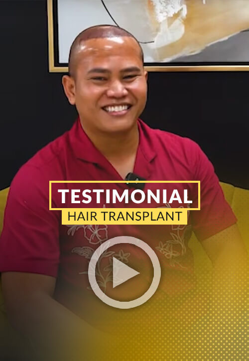 Raditio Catur tells his experience after hair transplant surgery in Miami | Care4Hair