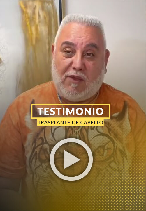 Testimonio de Nelson Rogers tras 5 meses de la cirugia de trasplante capilar.
