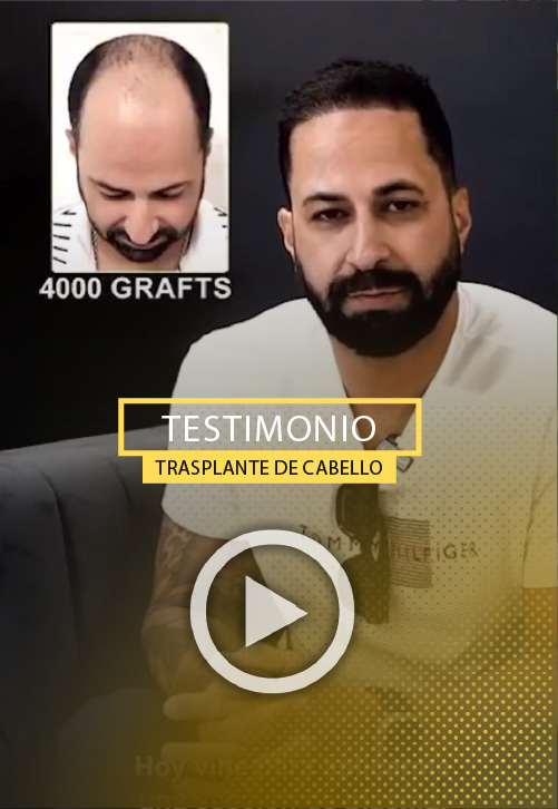 Trasplante de cabello de 4000 foliculos - TEstimonio y Resultados