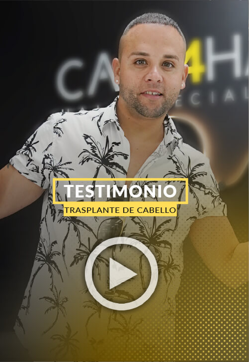 Trasplante de 3000 foliculos seis meses despues - Video Testimonio