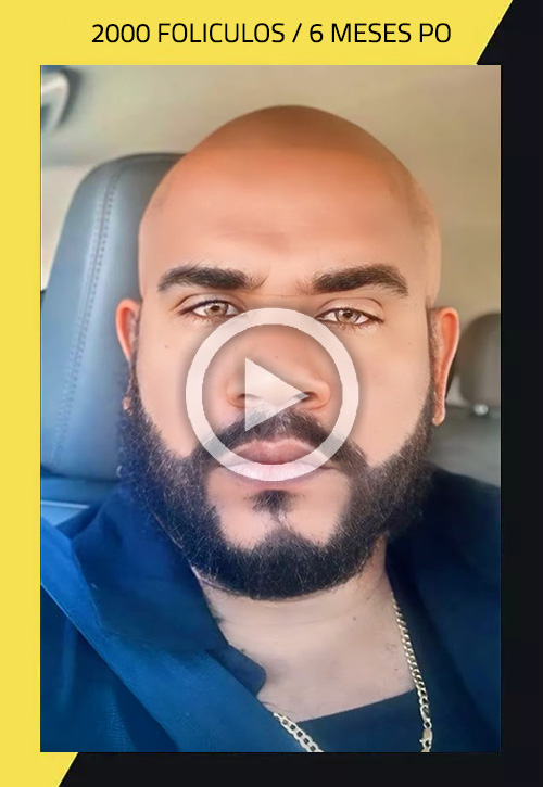 Transplante de cabello - paso a paso | Care4Hair