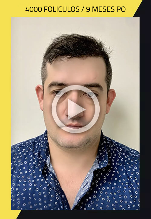 ¿Trasplante capilar? ¿Transformación capilar?