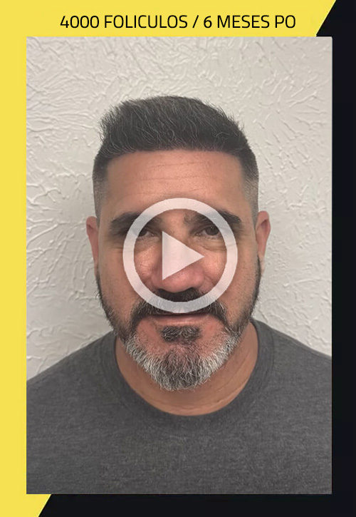 Trasplante de Cabello, un procedimiento sencillo que puede cambiar tu autoestima Care4Hair 