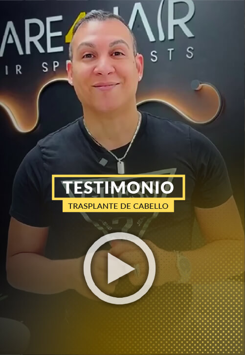 Testimonio de un paciente con alopecia tras 5 meses del trasplante