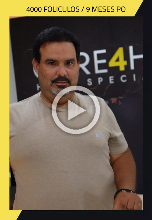 Restauración capilar en Care4Hair