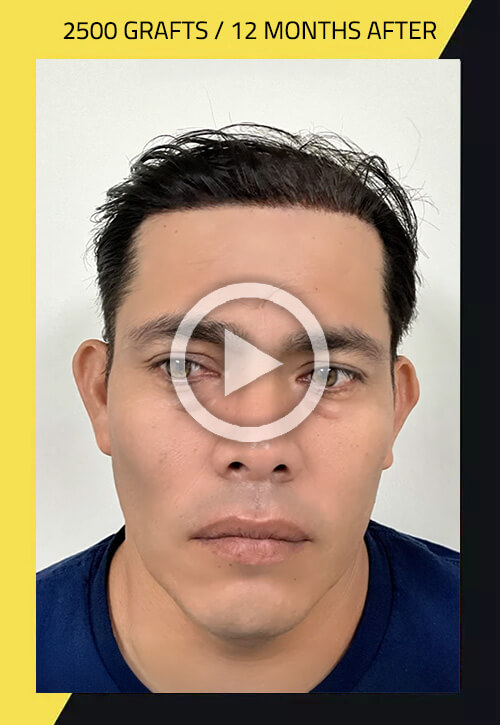 Hair transplant. Before and After of our patient | Care4Hair