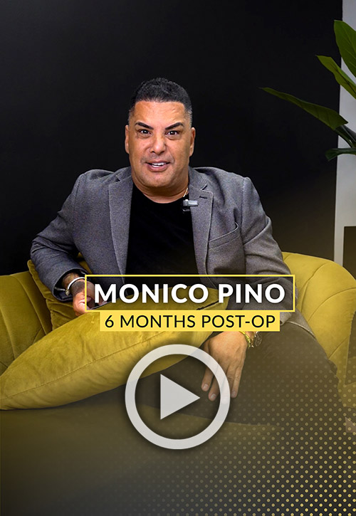 Monico Pino Hair Transplant Video Testimony - 6 months post-op