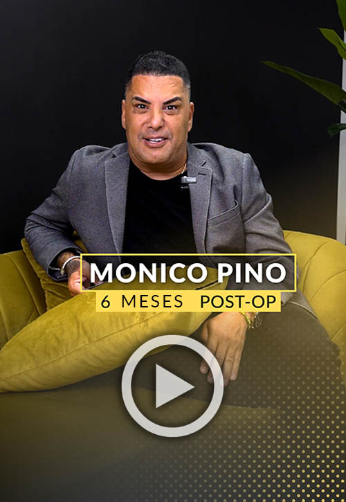 Testimonio en video del trasplante de cabello de Monico Pino - 6 meses después de la operación
