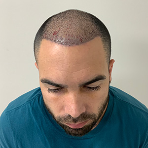 yasiel hair transplant 1 week after