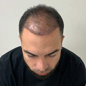 yasiel hair transplant 1 month after